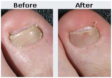 nail2