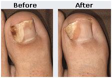 nail3