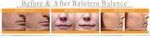 Belotero