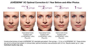 JuvedermXC