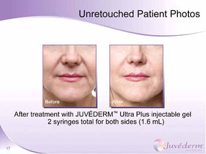 juvederm