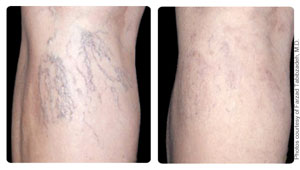 leg vein