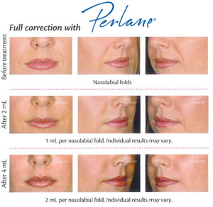 perlane