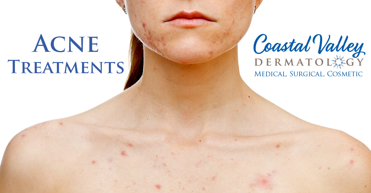 coastal-valley-dermatology-carmel-acne-face-chest-back-photo