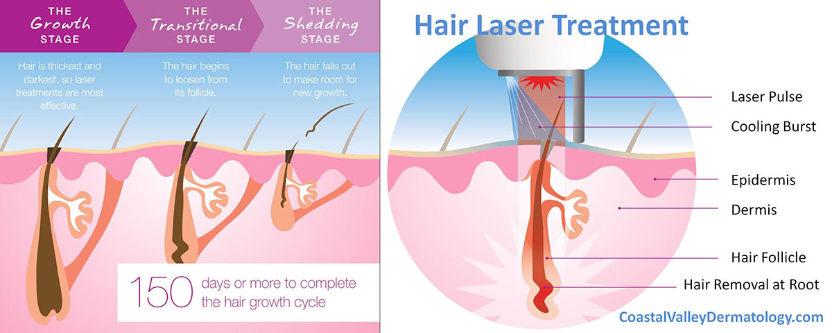 Laser Hair Removal | Coastal Valley Dermatology