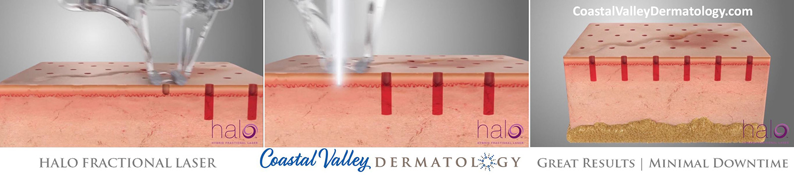 coastal-valley-dermatology-carmel-halo-dual-laser-rejuvenation-photo
