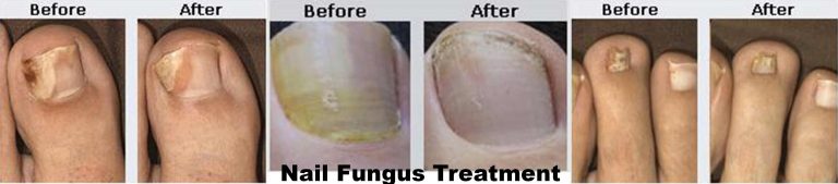 Nail Fungus - Coastal Valley Dermatology