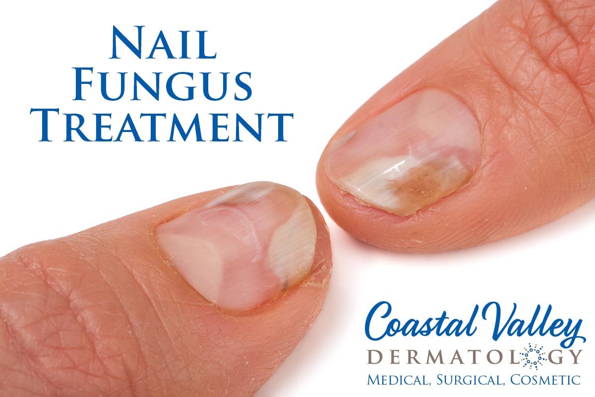 Nail Fungus Coastal Valley Dermatology