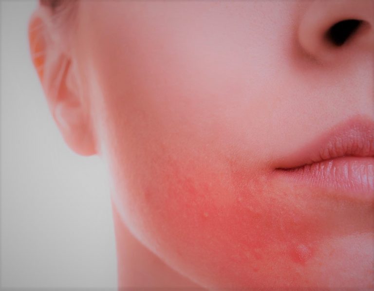 Rosacea & Redness - Coastal Valley Dermatology