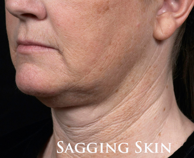 coastal-valley-dermatology-carmel-sagging-skin-treatment-photo