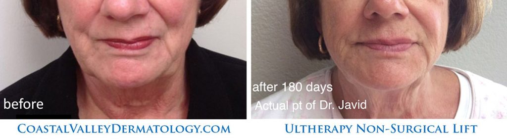 Ultherapy Skin Tightening - Coastal Valley Dermatology