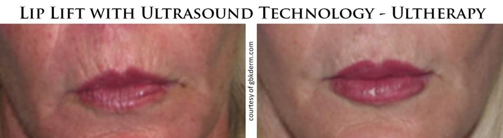 coastal-valley-dermatology-carmel-lip-lift-ultrasound-ultherapy-photo