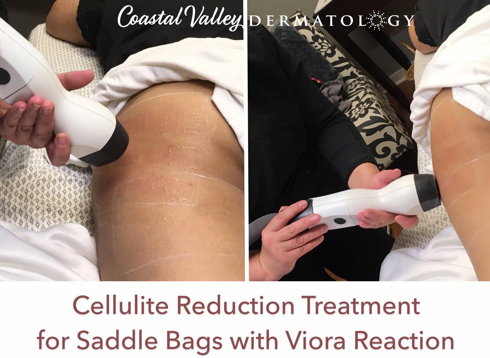 coastal-valley-dermatology-cellulite-saddle-bags-photo
